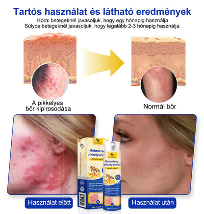 (🔥 60% kedvezmény az utolsó napi csomag vásárlásához 🔥) VitaNova™ PsoriaHeal psoriasis Spray pro🔥Globális szállítás