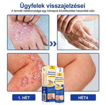 (🔥 60% kedvezmény az utolsó napi csomag vásárlásához 🔥) VitaNova™ PsoriaHeal psoriasis Spray pro🔥Globális szállítás