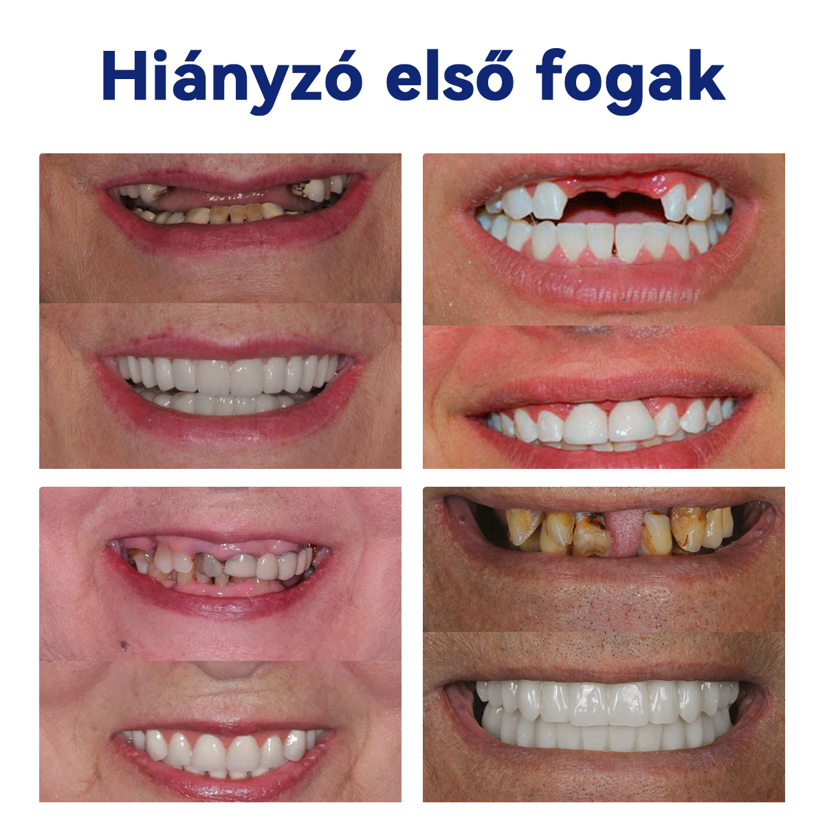 🦷Furzero™ szilikon műfogsor készlet🦷