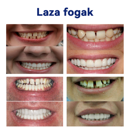 🦷Furzero™ szilikon műfogsor készlet🦷