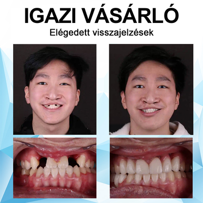 🦷Furzero™ szilikon műfogsor készlet🦷