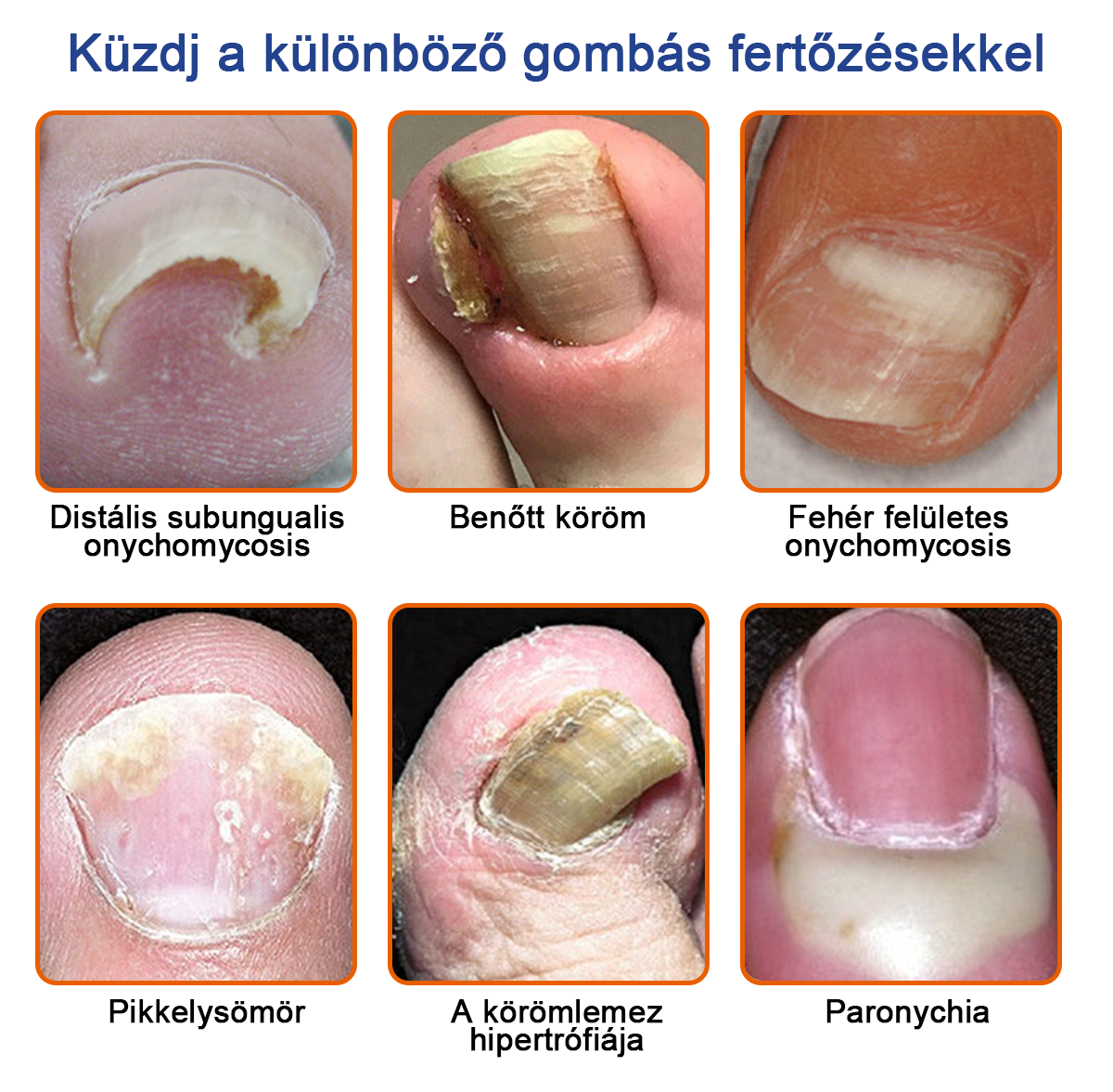 🐝🐝Furzero™ Méhméreg Körömgomba Kezelőoldat: Teljes megoldás a körömgomba problémájára🌟👣