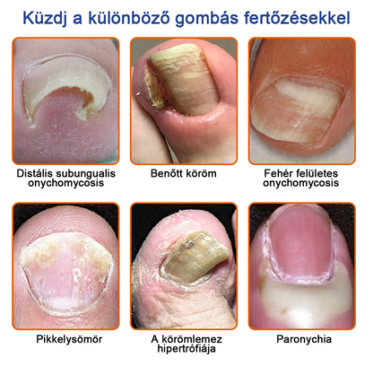 🐝🐝Furzero™ Méhméreg Körömgomba Kezelőoldat: Teljes megoldás a körömgomba problémájára🌟👣